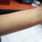 Salud Colima exhorta a identificar factores por alergia y acudir a recibir atención médica gratuita